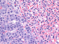 MPN-JAK2PCM1Biopsy-HE