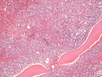 Acute promyelocytic leukemia (typical)