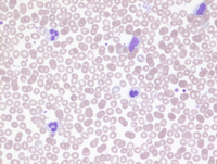 Polycythemia vera with progression