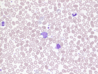 MPNPolycythemia-Vera