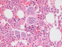 MPNPolycythemia-Vera