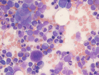 MPNPolycythemia-Vera