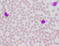 CLL cells with cytoplasmic vacuoles