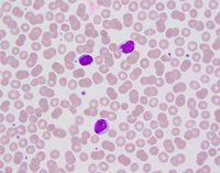 CLL cells with cytoplasmic vacuoles