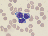 TProlymphocytic-leukemia