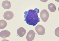 TProlymphocytic-leukemia