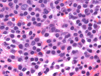 Myeloma