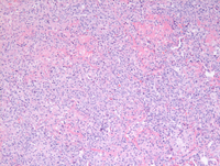 Lymphomatoid-granulomatosis