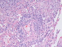 Lymphomatoid-granulomatosis