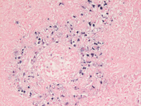 Lymphomatoid-granulomatosis