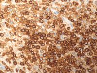 Splenic-marginal-zone-lymphomaBCL2