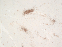 Splenic-marginal-zone-lymphomaCD79a