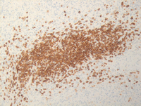 Splenic-marginal-zone-lymphoma