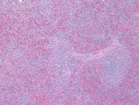 Splenic marginal zone lymphoma