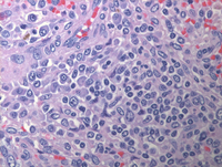 Splenic-marginal-zone-lymphomaHE