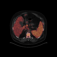 Blastoid Mantle cell lymphoma-Cyclin D1-negative