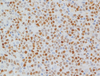 Mantle-cell-lymphomaSOX11