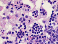 RosaiDorfman-diseaseHE