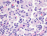 RosaiDorfman-diseaseHE