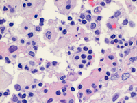 RosaiDorfman-diseaseHE