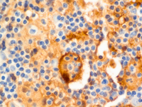 RosaiDorfman-diseaseS100