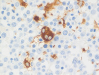 Myeloid-NeoplasmGATA2Pedigree