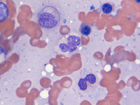 Myeloid Neoplasm-GATA2-proband