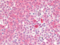 Myeloid-NeoplasmGATA2Pedigree