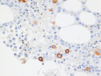 Myeloid-NeoplasmGATA2Pedigree