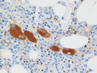 Myeloid-NeoplasmGATA2proband