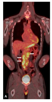 Histiocytic sarcoma in patient with prior B-Lymphoblastic leukemia