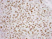 Histiocytic sarcoma-PU.1