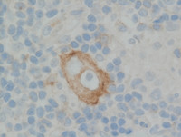 CD30 Reed-Sternberg cell