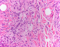 ErdheimChester-Disease