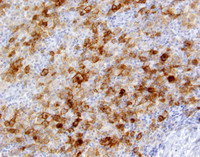 Indeterminate-dendritic-cell-tumorCD1a