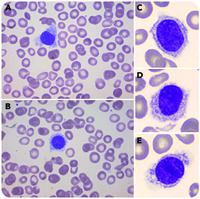 Hairy cell leukemia in a child?!