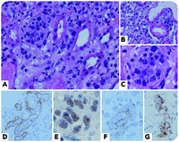A rare case of renal intravascular NK/T-cell lymphoma