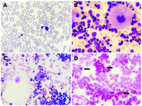 Bone marrow histopathologic findings in SIFD syndrome: beyond the erythroid lineage