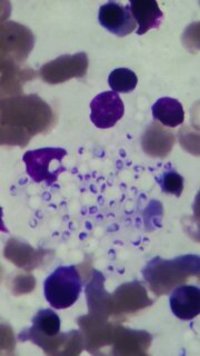 Histoplasmosis