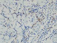 Current-Classification-WHO-2016-of-EBv-Tcell-and-NKcell-Proliferations