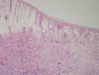 Current-Classification-WHO-2016-of-EBv-Tcell-and-NKcell-Proliferations