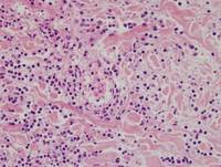 Current-Classification-WHO-2016-of-EBv-Tcell-and-NKcell-Proliferations