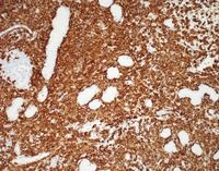 NKcell-enteropathyCD56