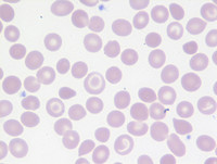 Betathalassemia-traitBlood