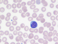 Beta-thalassemia trait