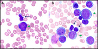 Concomitant acute myeloid leukemia and large granular lymphocytic leukemia in a patient with fevers