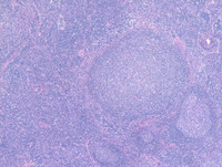 Progressive transformation of germinal centers (PTGC)