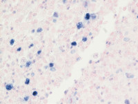 EBV-reactivationEBER