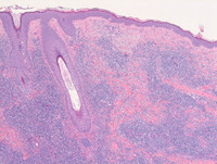Primary cutaneous small medium T-cell lymphoproliferative disorder