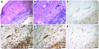 Cutaneous intralymphatic CD30 pseudolymphoma: a reactive condition mimicking lymphoma
